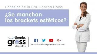 Ortodoncia estética en Málaga con Gross Dentistas - ¿Se manchan los brackets estéticos?