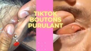 TIKTOK BOUTON PIMPLE POPPING 5