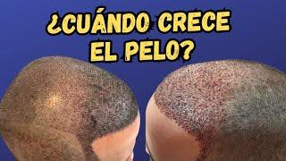 ¿Cuándo SALE el PELO en un  TRASPLANTE CAPILAR? ¿Cuándo me debo preocupar?