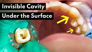 How Dentists Treat INVISIBLE CAVITIES