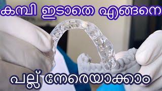 Kambi idathe pallu tazhan |കമ്പി ഇടാതെ പല്ല് നേരെയാക്കാൻ|How to straighten your teeth without braces