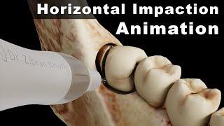 Innovative 3D Animation: Horizontal Impacted Mandibular Third Molar Extraction