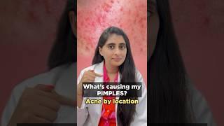 Pimples on face | How to treat acne and pimples on face | What acne means | Dermatologist