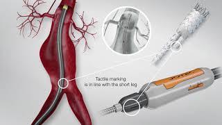 JOTEC E-tegra Stent Graft System Animation