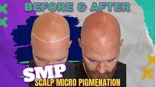 SMP - First Session Results - Scalp Micro Pigmentation