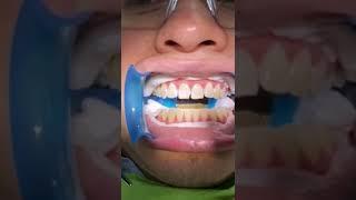 ¡ASÍ SE HACE UN BLANQUEAMIENTO DENTAL DE CONSULTORIO!