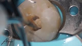 Pulp stone removal in the mandibular first molar using endodontic ultrasonic tip