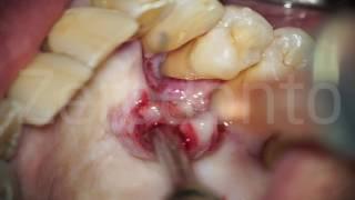 Minimally Invasive Periodontal Therapy (MIST) - Work in Progress | Dr. Fabio Cozzolino | Zerodonto