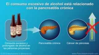 Cáncer de páncreas: signos, síntomas y factores de riesgo