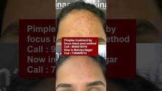 Best Pimples treatment by focus black peel method at skinaa clinic | Viral #shorts