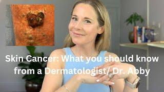 Skin Cancer: What you should know from a Dermatologist/ Dr. Abby