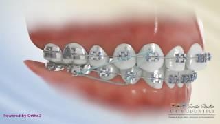 Elastics - Class II Triangle 3 to 4-6 - Orthodontic Treatment