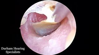 Thick Dead Skin Sheet Peeled Off Eardrum (Suction Extraction)