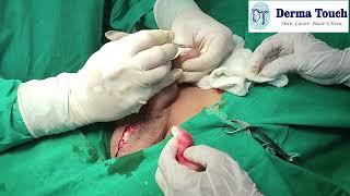 Gender change Genital Amputation Surgery Male to female लिंग परिवर्तन सर्जरी पुरुष से महिला