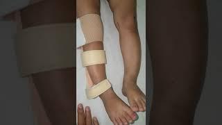 Bow legs in children -- Management