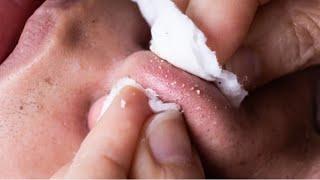 How To Remove Whiteheads & Blackheads #video #viral #youtubevideo #viralvideo @Ta-nujaaSparkle