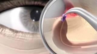 Punctum plug procedure - animation