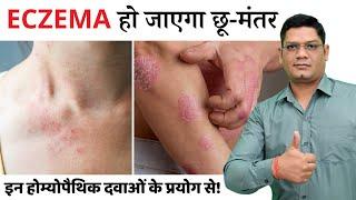 Eczema Homeopathy Best Medicine Treatment | Causes, Symptoms and More | Dr. Sunil Patidar #eczema