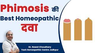 Best Homeopathic Medicine for Phimosis | Phimosis का बिना ऑपरेशन के इलाज  Best Treatment of Phimosis