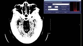 Window Width & Window Level (W/L) Concepts - CT Head Example