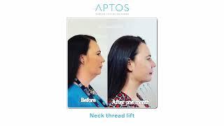 Aptos Thread Lifting  Light Lift Needle Method