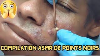 ASMR Extraction de Boutons et Points Noirs | Compilation Satisfaisante pour la Relaxation