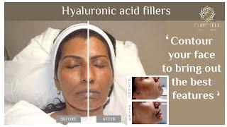 Hyaluronic acid filler - Dr Shanika Arsecularatne