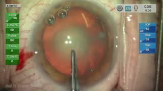 Routine Cataract Surgery Narrated Ike Ahmed