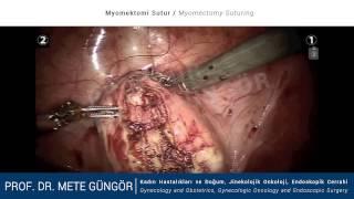 Robotik Myomektomi Sütür -  Robotic Myomectomy Suturing