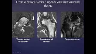 Базовый курс по МРТ  b  Лекция «МР семиотика повреждений тазобедренного сустава»  Лектор  Учеваткин