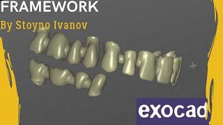 Upper Jaw and Lower Bridge Framework in EXOCAD