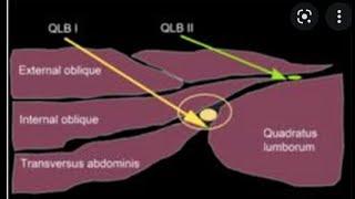 Quadratus Lumborum Block 1,2, 3 -Clinical tips.- Presentation by Dr Amit Dikshit