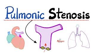 Pulmonic Stenosis (PS) - Pulmonic Valve Stenosis - Valvular Heart Disease (VHD) - Cardiology 🫀