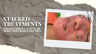 STACKED TREATMENTS FOR SUCCESSFUL ACNE SCAR REDUCTION WITH EMER SKIN | Dr. Jason Emer