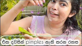 එක දවසින් කුරුලෑ නෑති කරන රහස  | Pimples removal on face at home  | Aloe vera ️