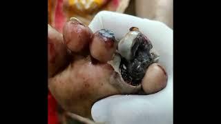 Foot infested with maggots | Surgeon removes worms from a patient’s foot