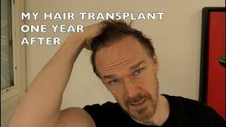 1 YEAR  AFTER MY HAIR TRANSPLANT