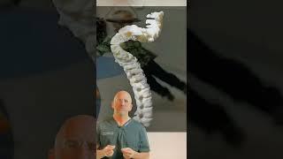 Halo-Traction Therapy for SEVERE Kyphoscoliosis #shorts