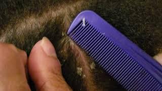 Dandruff Scratching | Nape Dandruff Removal With Comb
