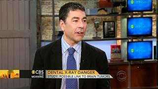 CBS This Morning - Dental X-rays linked to brain tumors: study