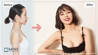 [Plastic Surgery in Korea] Mom Breast Implant Surgery before and after) || sagging breast, mother