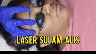 LASER SULAM ALIS || LASER TATO ALIS