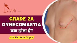 Grade 2A Gynecomastia क्या होता है?