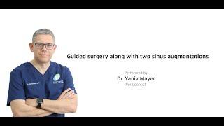 Guided surgery along with two sinus augmentations. Performed by Dr.  Yaniv Mayer, Periodontist