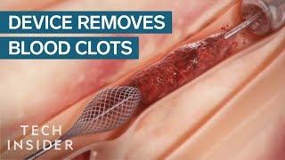 How This Device Safely Removes Blood Clots | Tech Insider