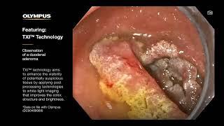 Observing Adenomas with TXI™ Technology