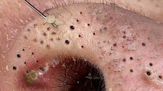 Blackheads & Milia,Huge Nose acne blackheads extraction New This Week Pimple Popping.