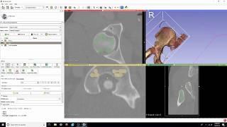 DICOM to STL Conversion Tutorial with Segment Editor