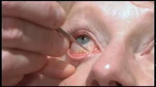 Oculoplastics basic exam: Lacrimal system examination