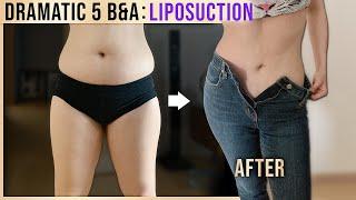 Outstanding Body Liposuction Before and After Results in Korea Plastic Surgery | Quick & Effective!